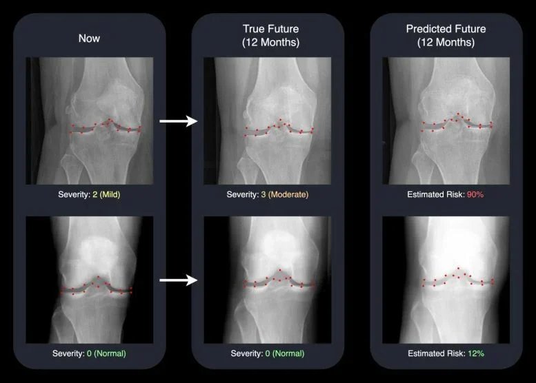 AI Brings Tomorrow&rsquo;s X-Rays to Life, Helping Doctors Fight Arthritis Sooner